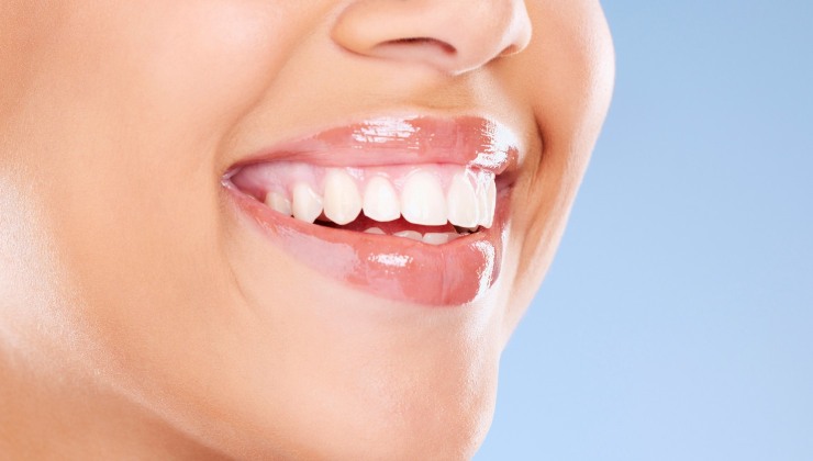 Digital Smile Design faccette dentali 